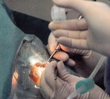 Subsidian 210 cirugías de cataratas