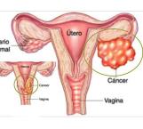 Lo que debes saber sobre el cáncer de ovario