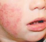 Afecta a niños dermatitis atópica